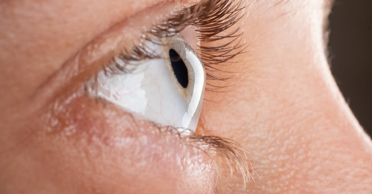keratoconus treatment boise